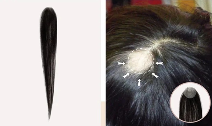 No more bals spot on crown, hair patches for women are the perfect cover-up solution