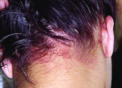 Scalp sensitivity