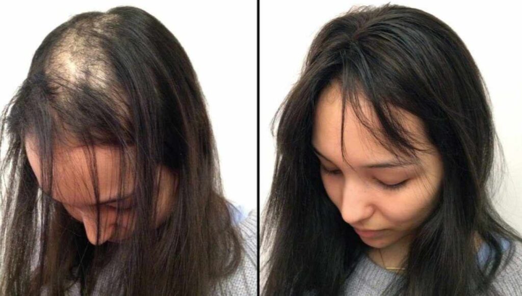 Crown hair toppers for thinning hair