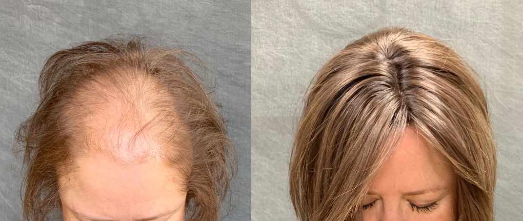 How To Cover Hair Thinning On Top: Hair Toppers For Thinning Crown