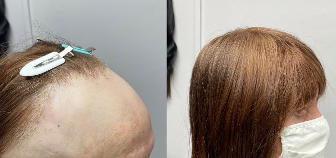 Frontal Hair Loss and Lace toppers