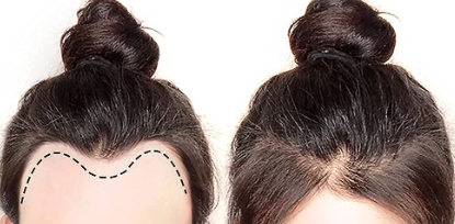 Hair Loss in the front and lace hairpieces