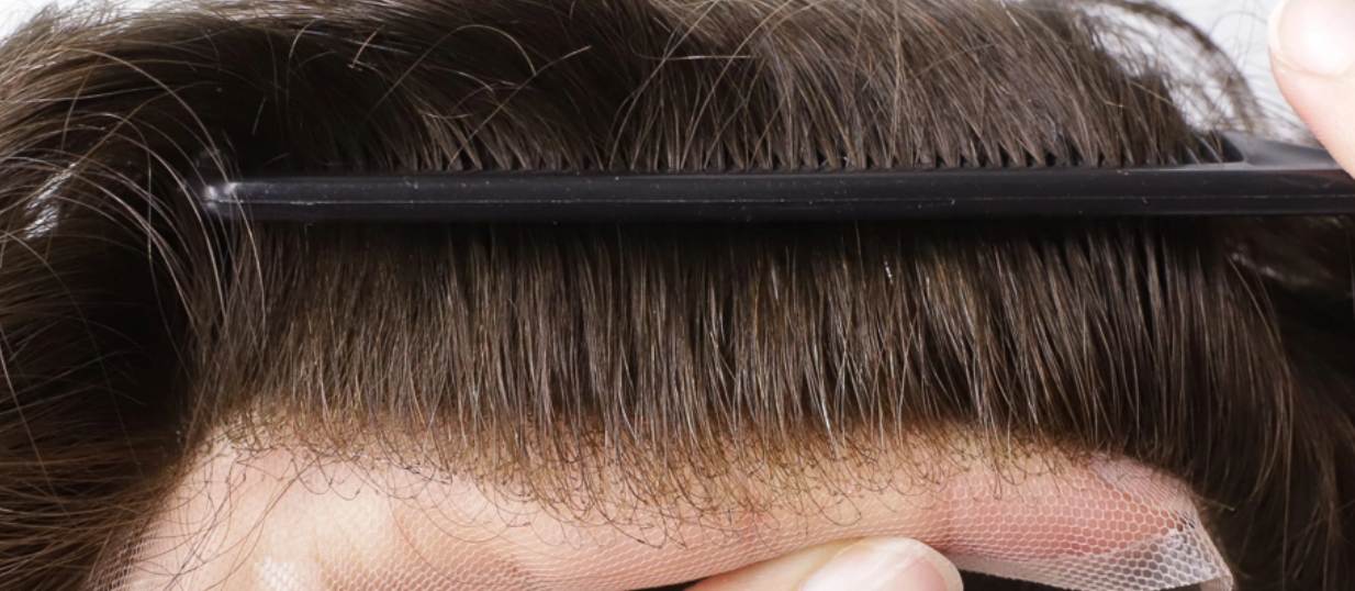 Frontal Hair Loss solutions